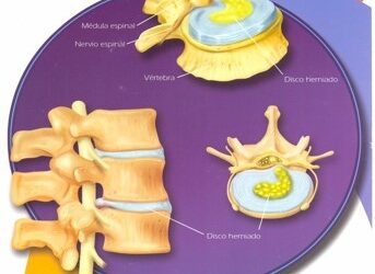 Hernias de disco: tratamiento sin cirugía