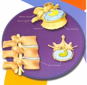 hernias-1