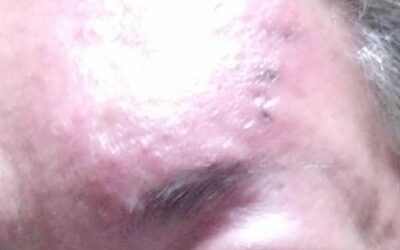 Paciente con Herpes Zoster severo, afectando incluso ojo