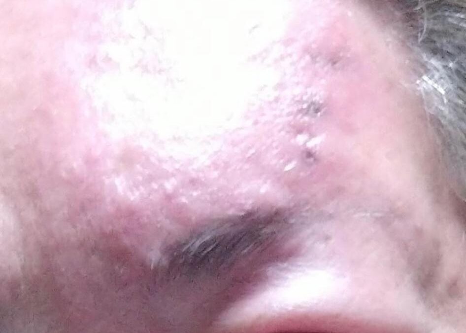Paciente con Herpes Zoster severo, afectando incluso ojo